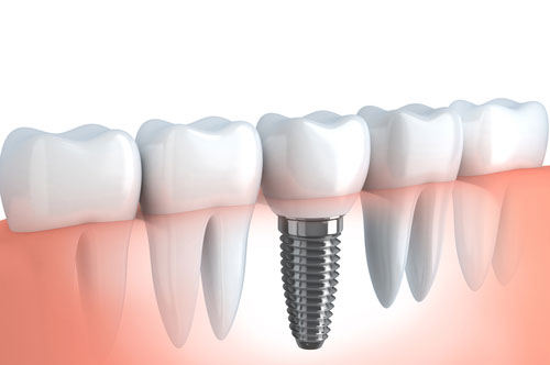 Enjoy a Festive Feast with Dental Implants This Season [BLOG]